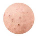 Enlarged Pore Tissue