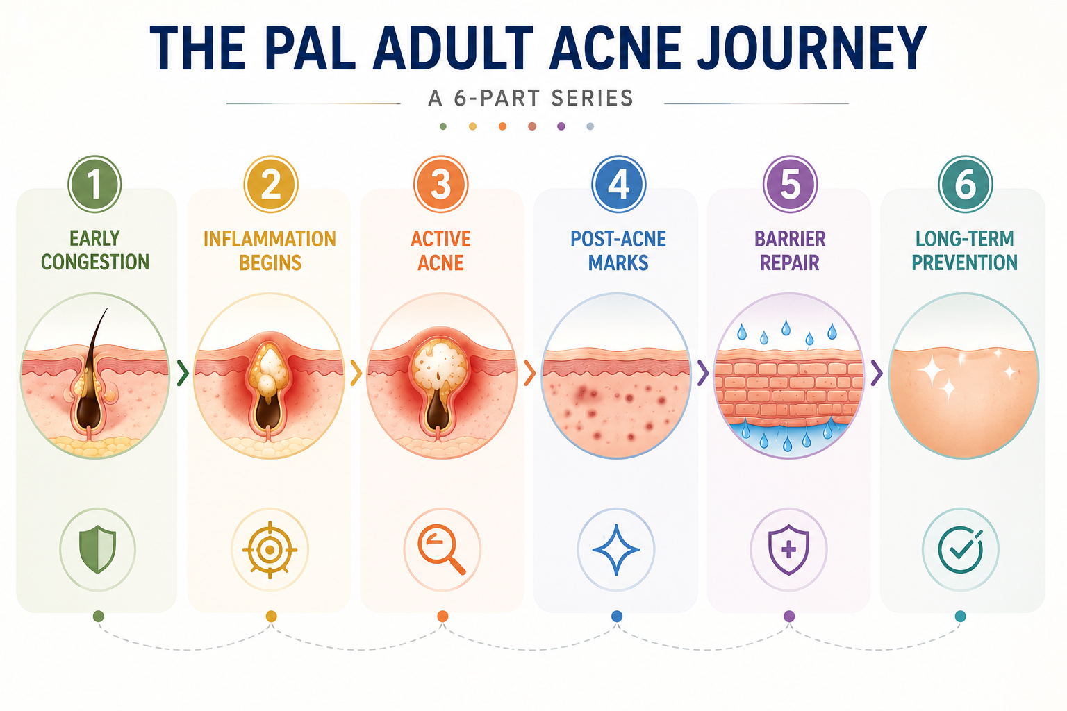 Overview diagram of the PAL Adult Acne Journey six-part series showing stages from Early Congestion to skin recovery
