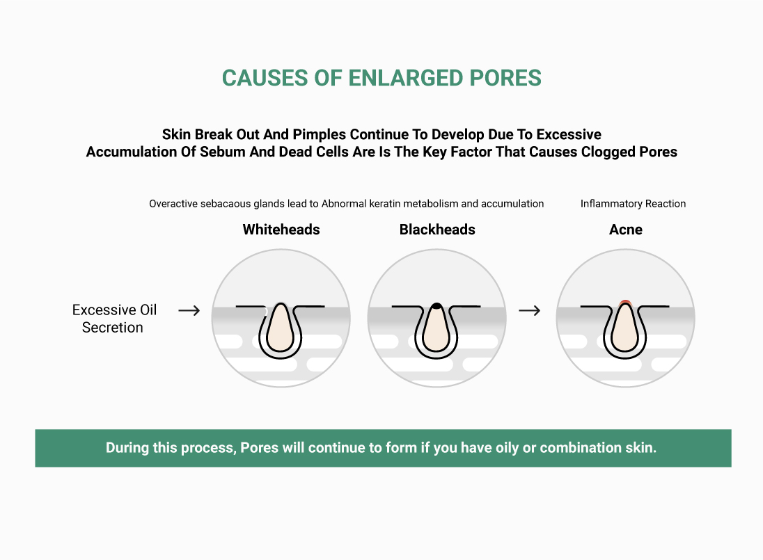 Pore Refining Serum - Causes of Enlarged Pores