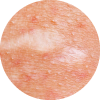Enlarged Pore Tissue